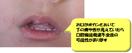 お口がポカンとして舌や歯が見えていたら口腔機能発達不全症の可能性があります
